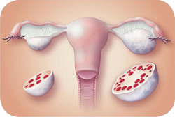 sindrome del ovario poliquistico, POLYCYSTIC OVARY SYNDROME