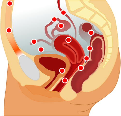 Endometriosis Endometriosis
