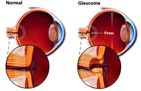 Glaucoma Glaucoma