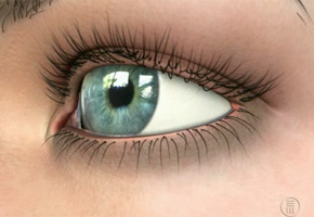 Glaucoma Glaucoma