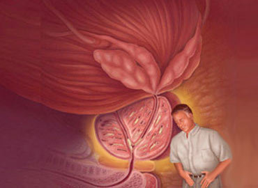 Prostatitis Prostatitis